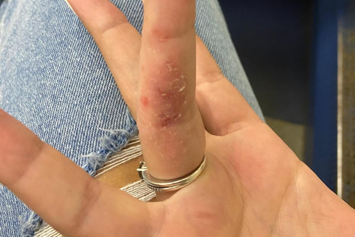 Neuzveicamā cīņa ar atopisko dermatītu